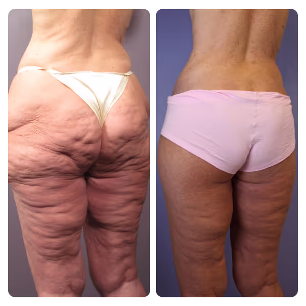 Thigh Lift in Turkey